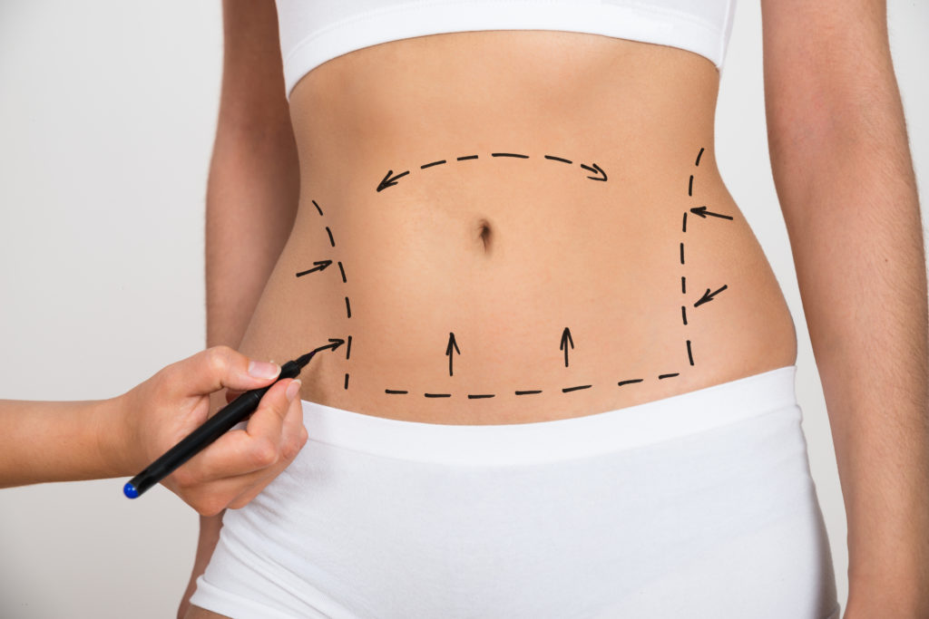 Liposuction and the Role of Exercise in Maintaining Results