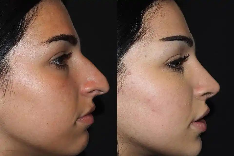 Rhinoplasty in Dubai: When to Resume Exercise