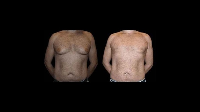 Diet and Exercise Tips for Maintaining Results After Male Breast Reduction Surgery